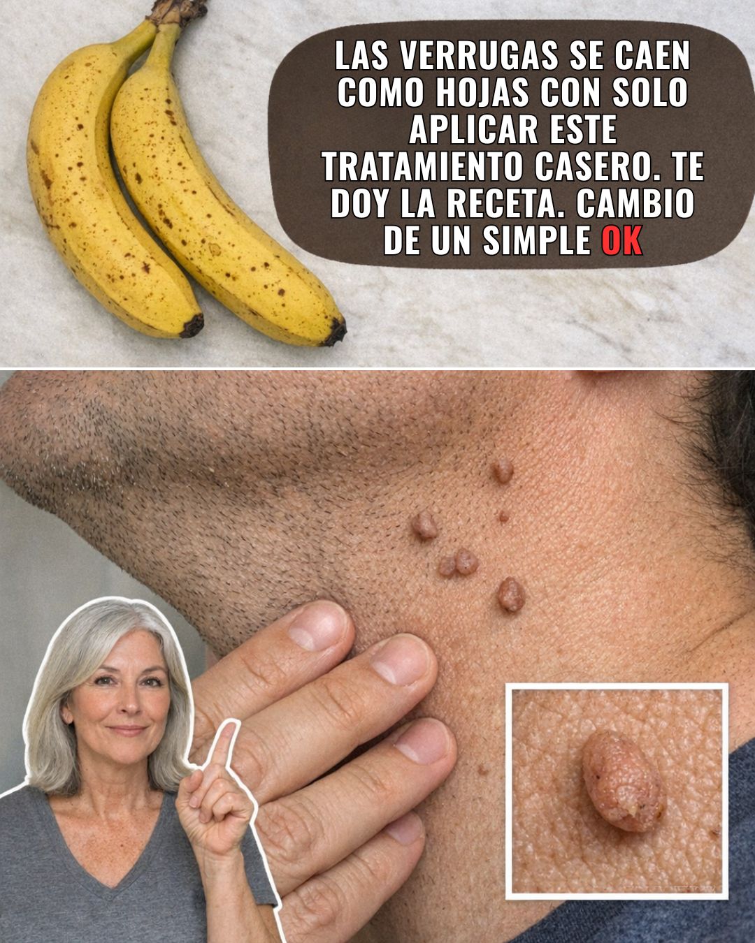 Cáscara de Plátano y Otros Ingredientes Naturales para el Cuidado de Verrugas