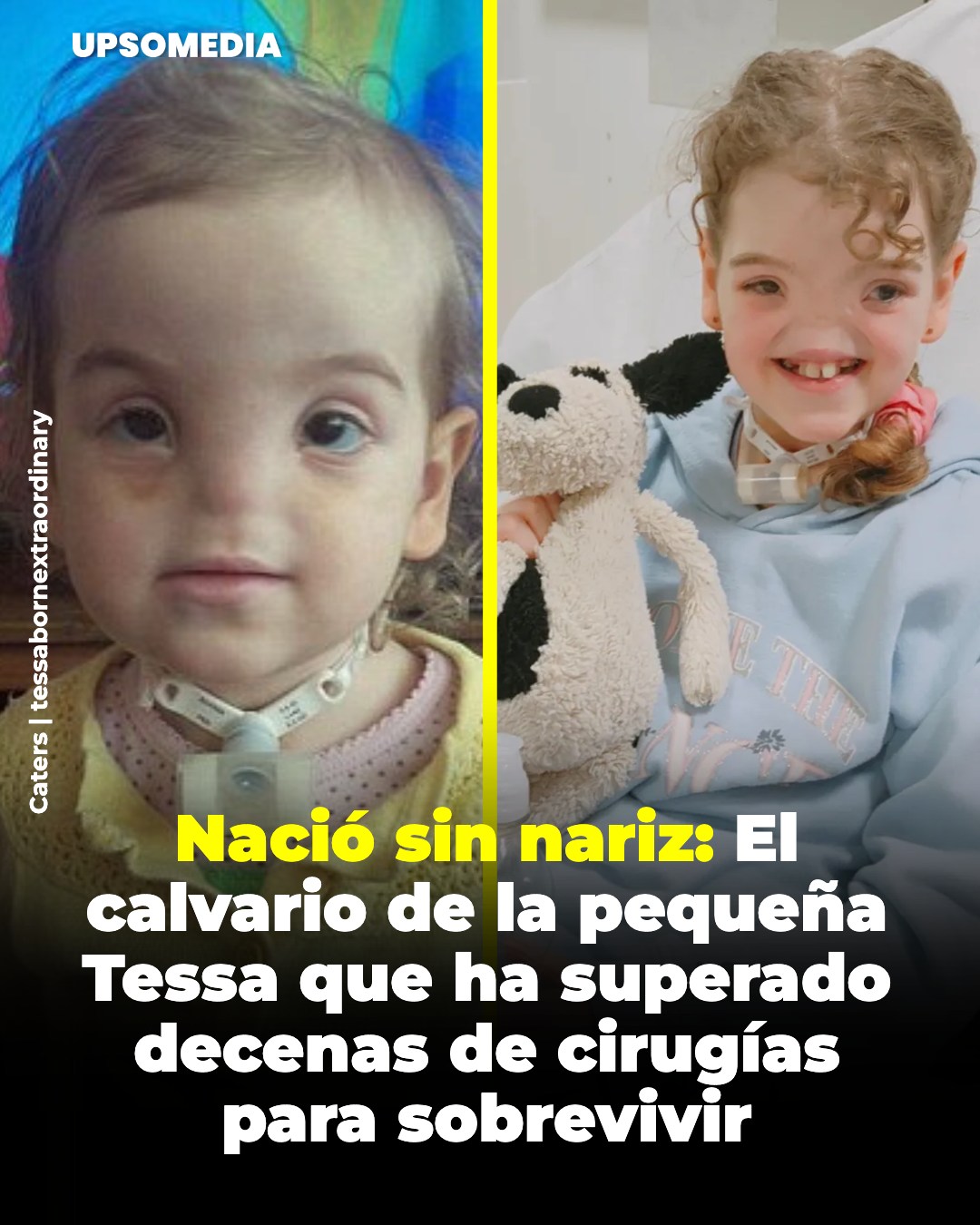 Tessa Evans nació con una condición extremadamente rara llamada arrinia completa congénita,